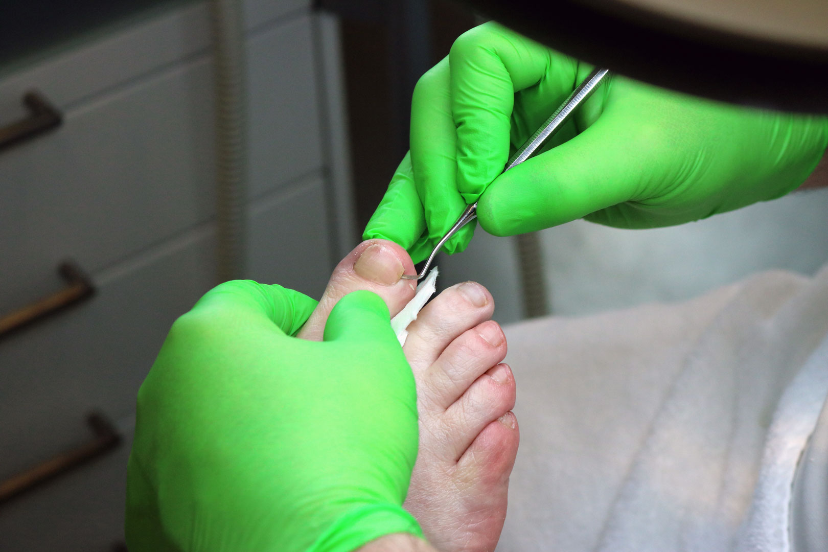 Nicht-invasive Behandlung eines eingewachsenen Zehennagels in Zürich durch diplomierte Fusspflege