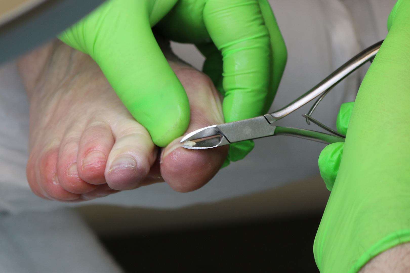 Behandlung eines eingewachsenen Zehennagels in Zürich durch diplomierte Fusspflege