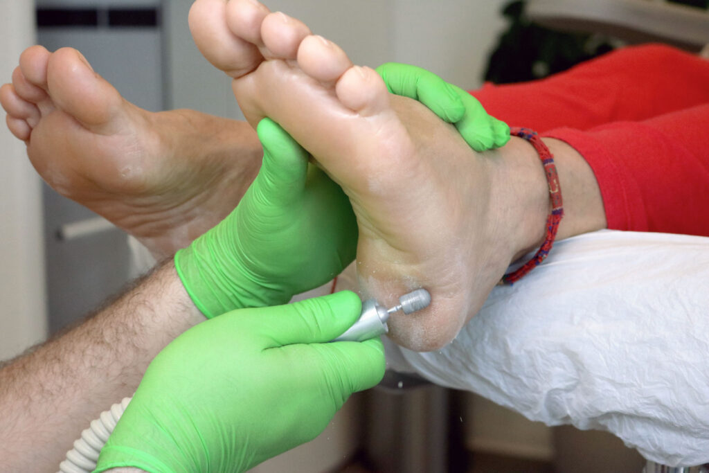 Behandlung von Hornhaut im Fersenbereich bei der Fusspflege in Zürich