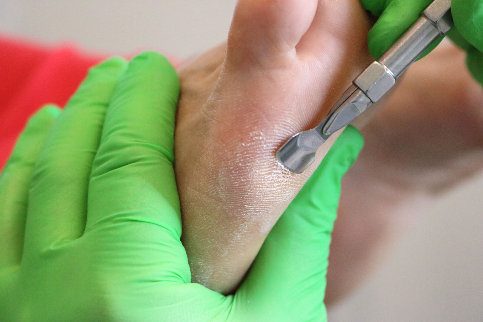 Behandlung von Hornhaut an der Fusssohle in Zürich durch diplomierte Fusspflege